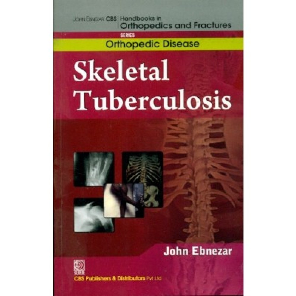 John Ebnezar CBS Handbooks in Orthopedics and Fractures: Orthopedic Disease : Skeletal Tuberculosis